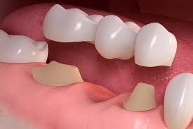 What Are Dental Bridges And Their Working?